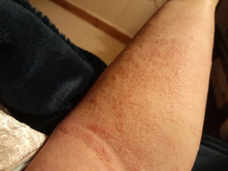 Anyone know what this itchy rash is 
