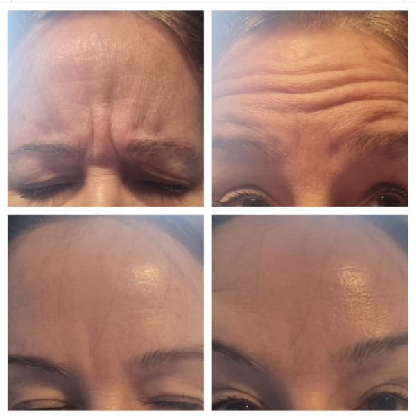 Age is not being kind… with pic! Botox needed, and what else??