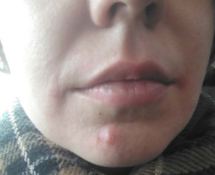 Nasolabial folds at 32?