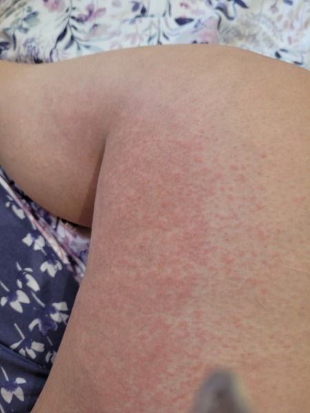 Rash - pic included