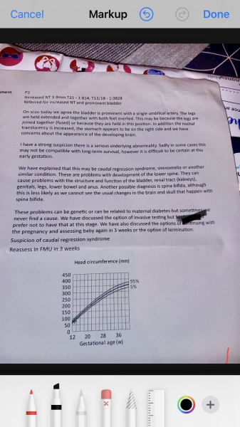 High risk in screening test and high NT