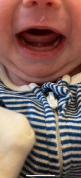 Miserable baby - teething? (Pic) 