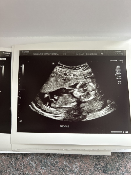 Nub and potty shot guesses (13 weeks 4 days)
