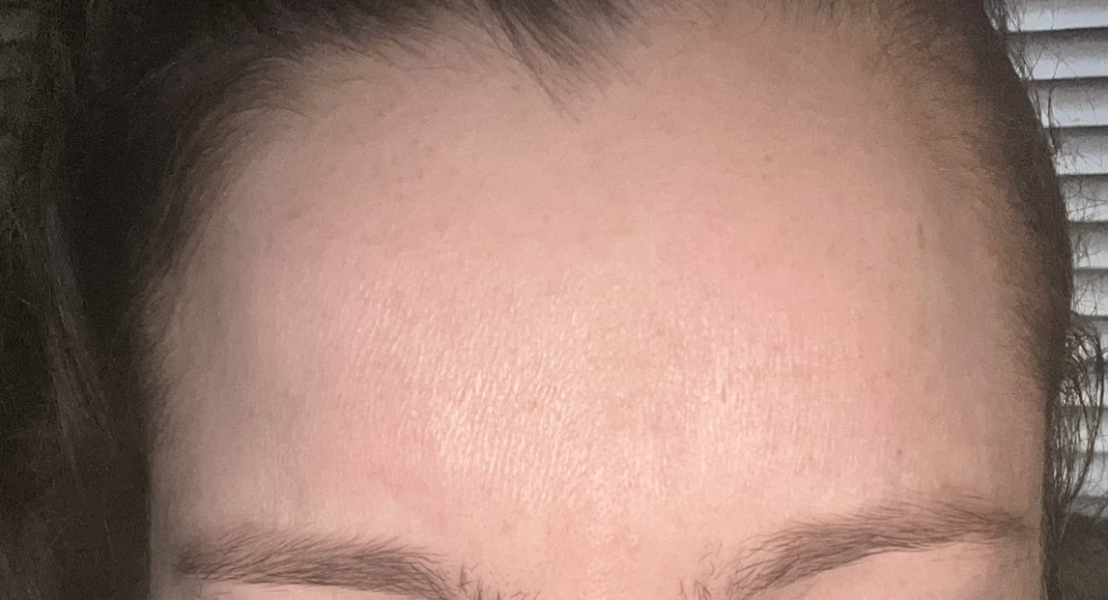 Tell me about Botox...