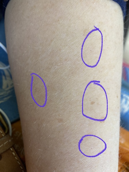 Tiny red spots on arms