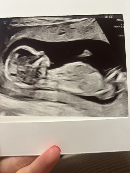 Any nub shown on scan ? 