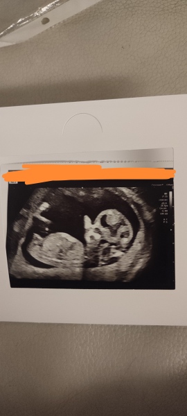 Nub theory. Has sonographer given it away?