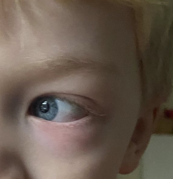 What does this look like on my 4 year old son’s eye? 