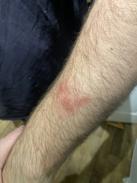 What’s this rash on my husband? Driving me insane!