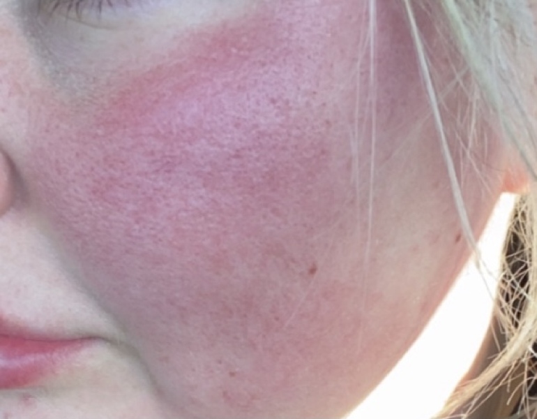 Wtf is going on with my face?!