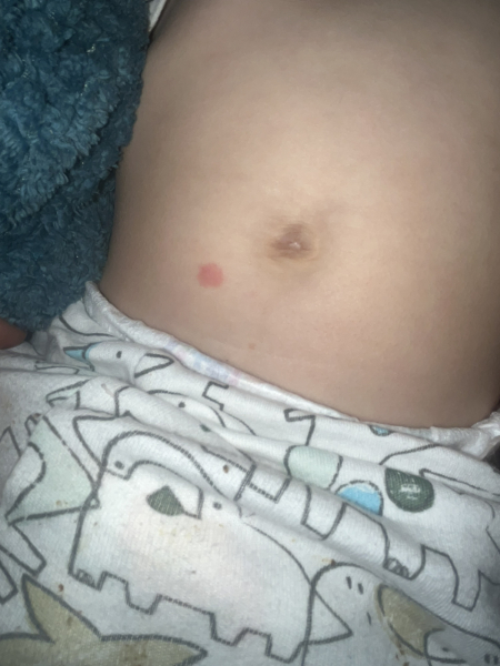 Is this chicken pox?