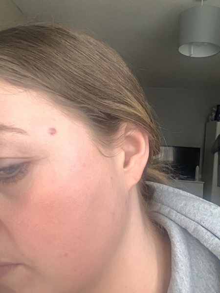 Little lump on face - anyone know what this is?
