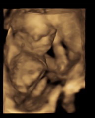 Birthmark on 4D ultrasound?? 
