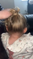 Mastoiditis?