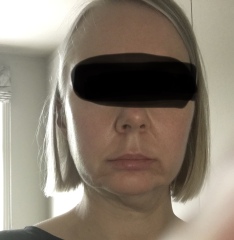 My droopy jowl mini face lift result pics