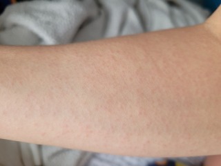 Prickly arm rash