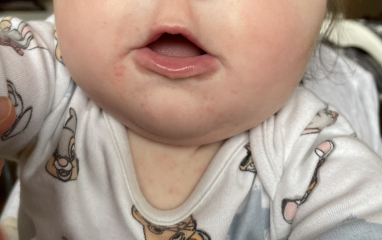 Is this a food allergy rash