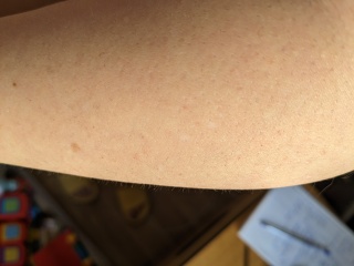 Angiomas and petechiaes after pregnancy?