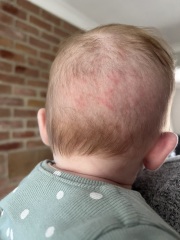 Rash on DDs head?