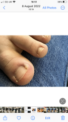 Is this an ingrown toenail?  Pic included!