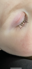 Sons eye is swollen, red and yellow discharge….