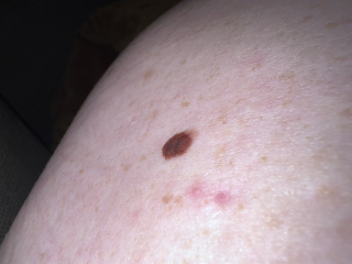 To tell you all to check your moles! (and wear good SPF) 