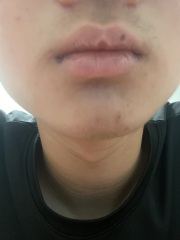 Mole on lip (I think!) pic attached