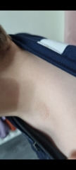 Rash
