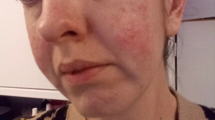 Is this rosacea?