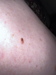 To tell you all to check your moles! (and wear good SPF) 