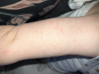 Is this chicken pox?