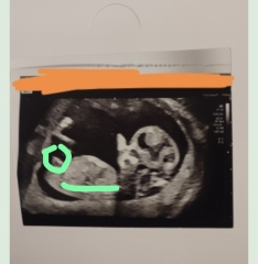 Nub theory. Has sonographer given it away?