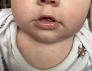 Is this a food allergy rash