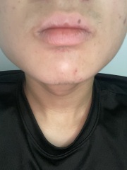 Mole on lip