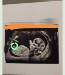 Nub theory. Has sonographer given it away?