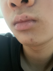 Mole on lip (I think!) pic attached