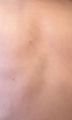 Chickenpox 
