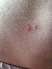 Chicken pox or?