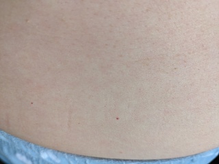 Angiomas and petechiaes after pregnancy?