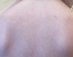 Chickenpox 