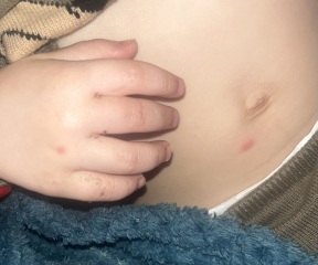 Is this chicken pox?