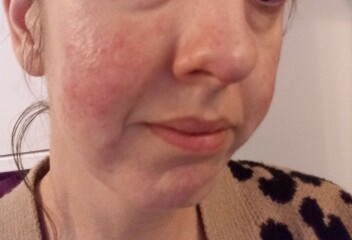 Is this rosacea?