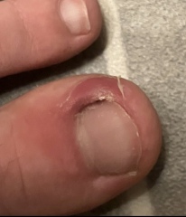 Is this an ingrown toenail?  Pic included!