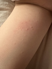 What is this rash?!