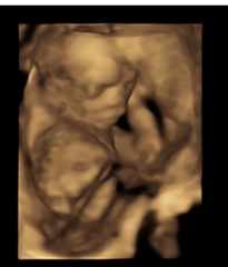 Birthmark on 4D ultrasound?? 