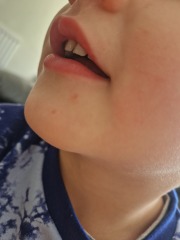 Is this the start of chicken pox?