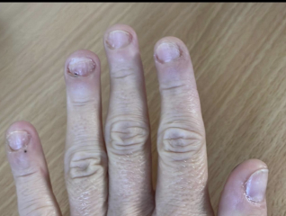 CBT therapy ? Did it help?