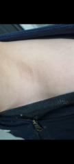 Rash