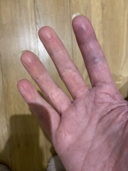 Intermittent blue finger after surgery 