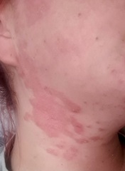 Psoriasis -advice before GP appointment 